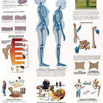 3B Anatomical Chart - Osteoporosis 20 x 25in