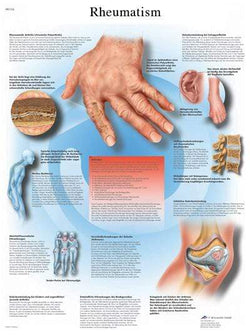 3B Anatomical Chart - Rheumatic Diseases 20 x 26''