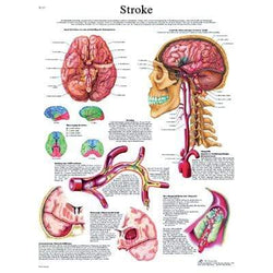 3B Anatomical Chart - Stroke Chart 20 x2 6''